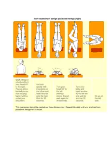 Home-Epley-Maneuver thumbnail