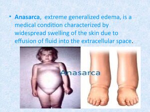 A Case Presentation On Anasarca With CCF thumbnail