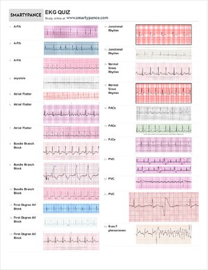 Thumbnail for Practice Ekg Strips With Answers