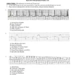 Practice EKG Strips With Answers