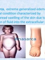 Thumbnail for A Case Presentation On Anasarca With CCF