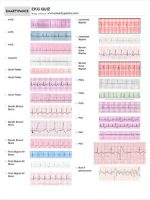 Thumbnail for Practice Ekg Strips With Answers
